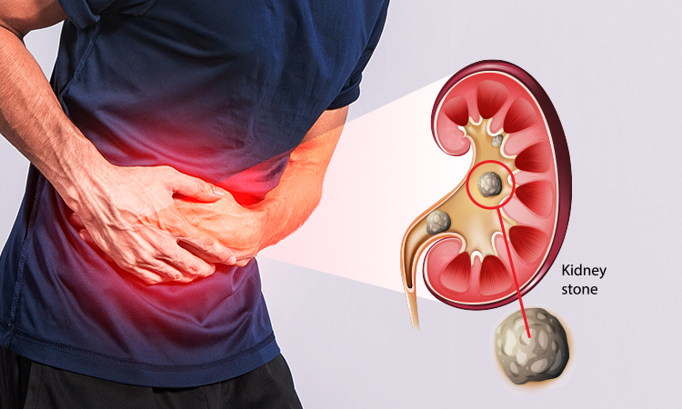 kidney-stone-treatment-chembur-mumbai